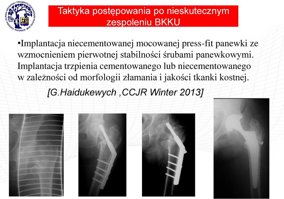 stabilności śrubami panewkowymi.