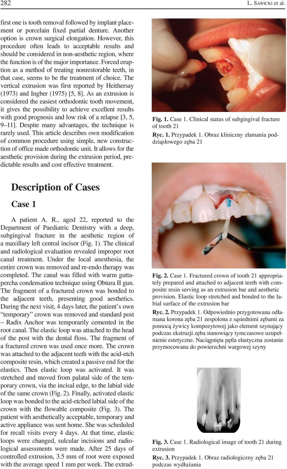 Forced erup tion as a method of treating nonrestorable teeth, in that case, seems to be the treatment of choice.