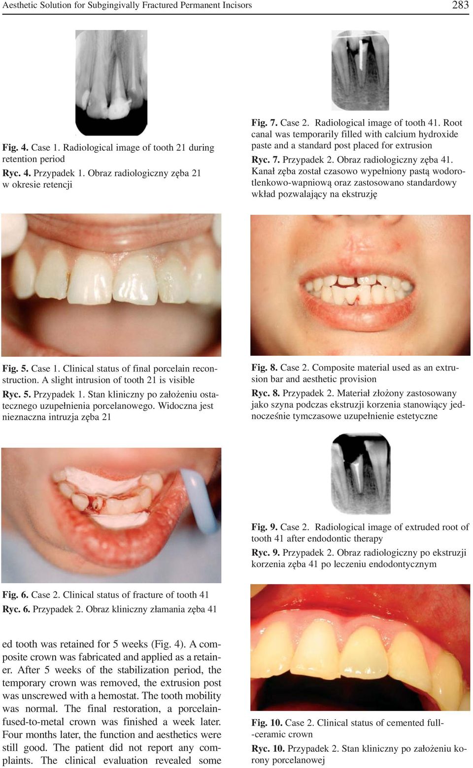 Root canal was temporarily filled with calcium hydroxide paste and a standard post placed for extrusion Ryc. 7. Przypadek 2. Obraz radiologiczny zęba 41.