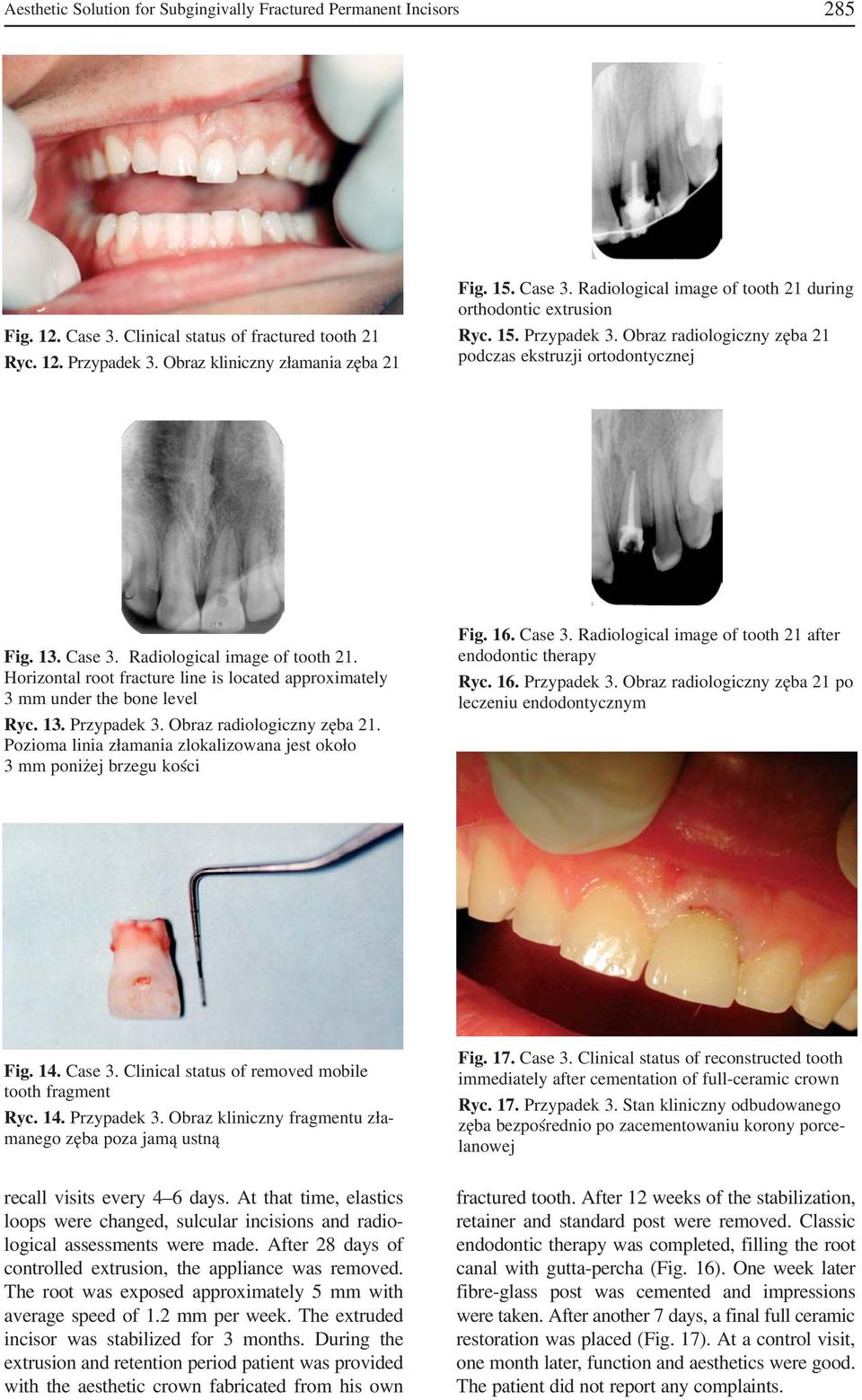 Horizontal root fracture line is located approximately 3 mm under the bone level Ryc. 13. Przypadek 3. Obraz radiologiczny zęba 21.