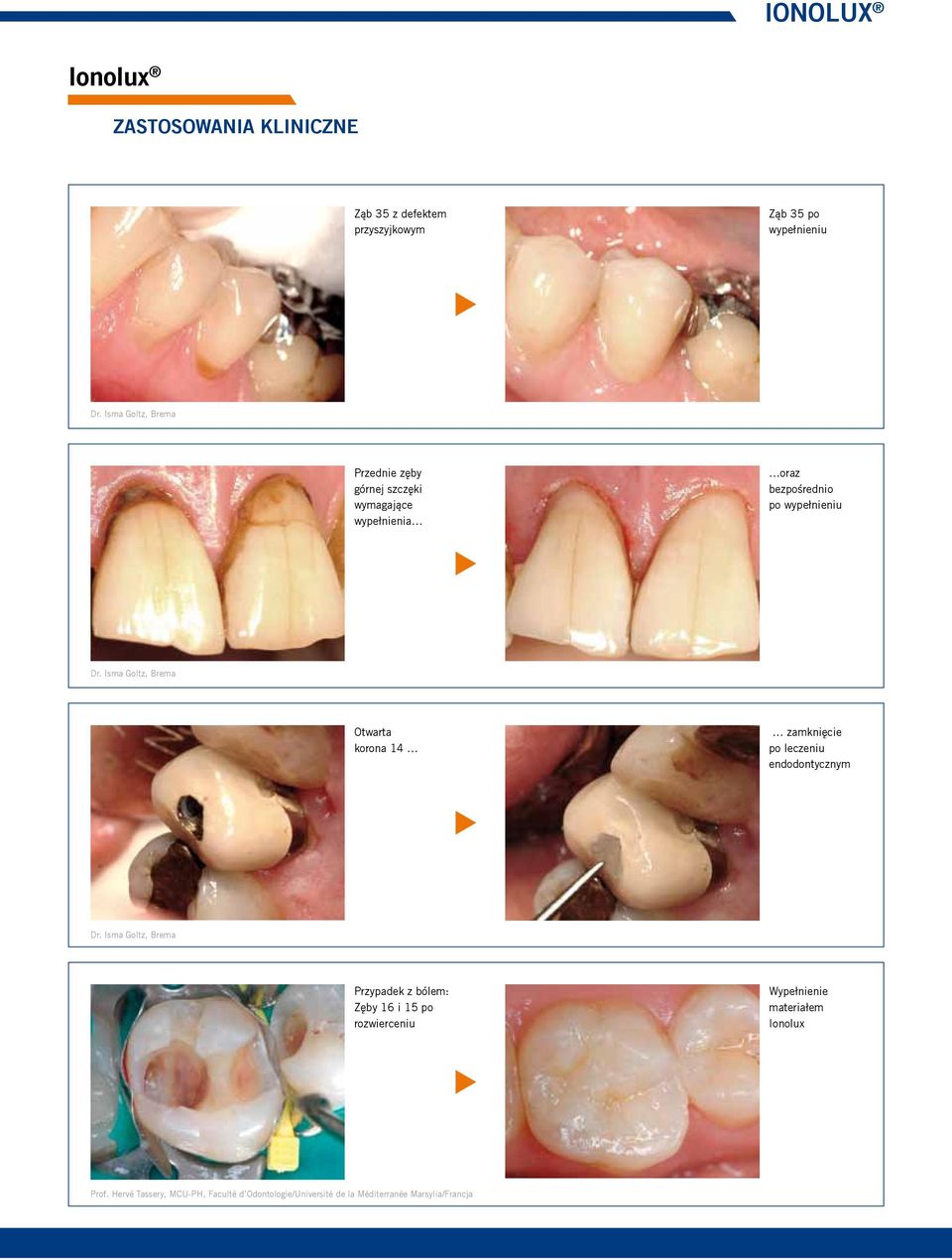 Isma Goltz, Brema Otwarta korona 14 zamknięcie po leczeniu endodontycznym Dr.