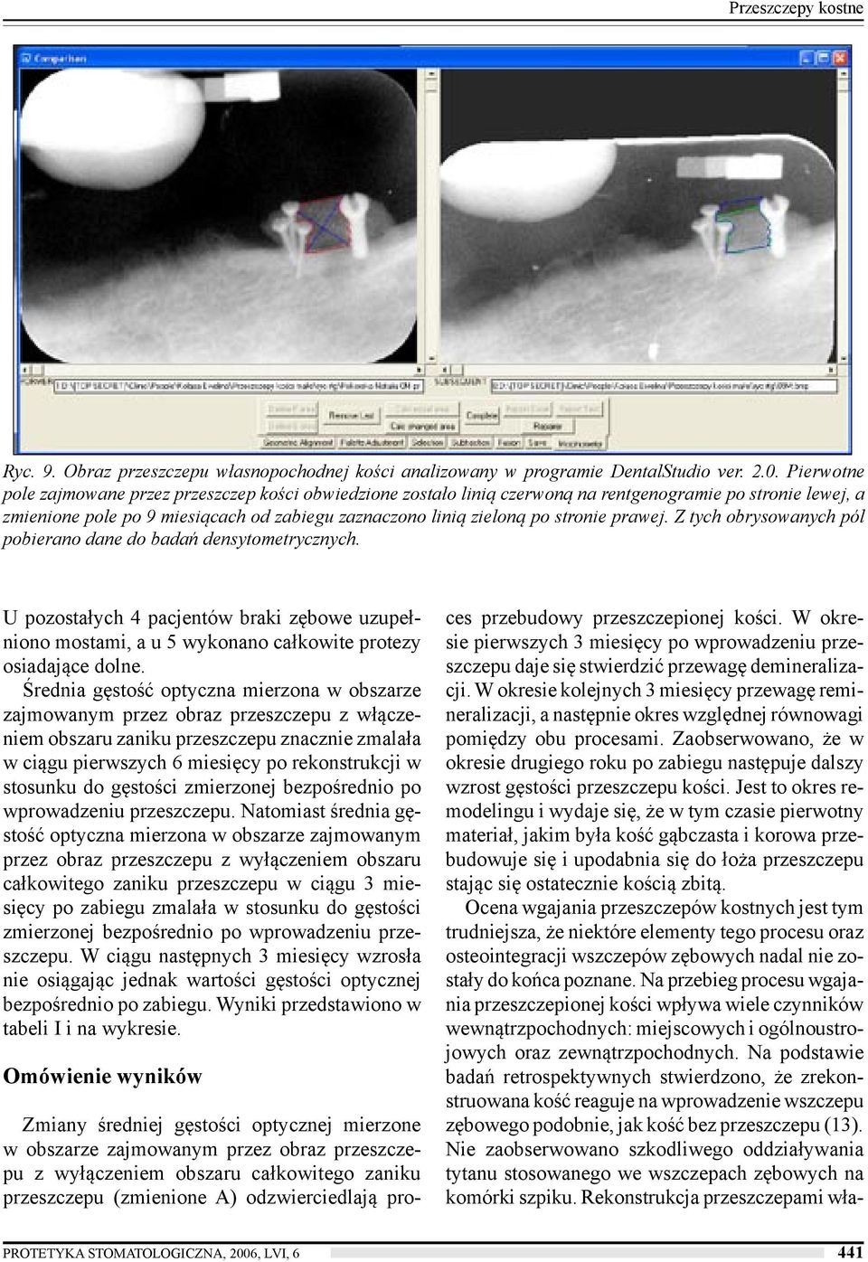 prawej. Z tych obrysowanych pól pobierano dane do badań densytometrycznych. U pozostałych 4 pacjentów braki zębowe uzupełniono mostami, a u 5 wykonano całkowite protezy osiadające dolne.