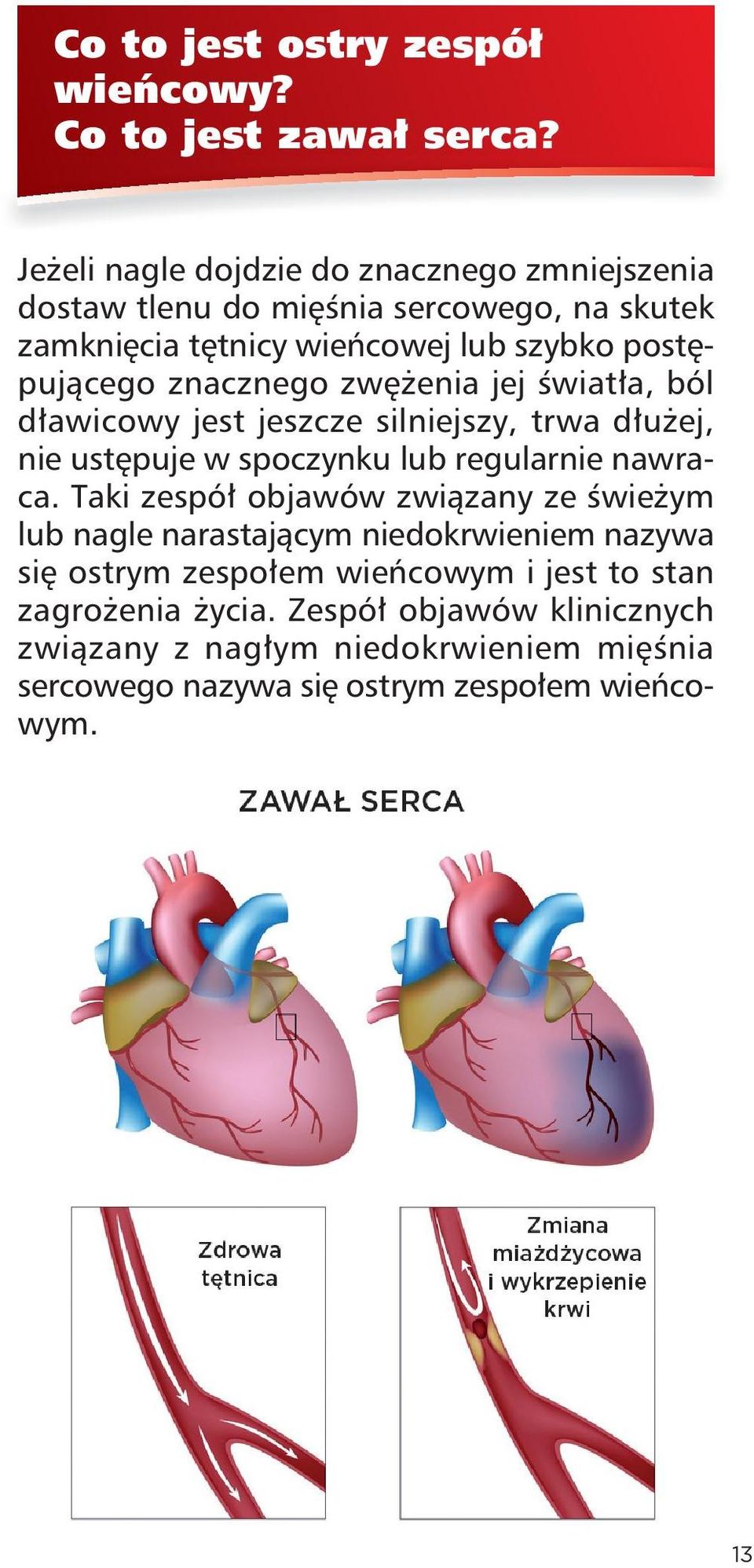 znacznego zwężenia jej światła, ból dławicowy jest jeszcze silniejszy, trwa dłużej, nie ustępuje w spoczynku lub regularnie nawraca.