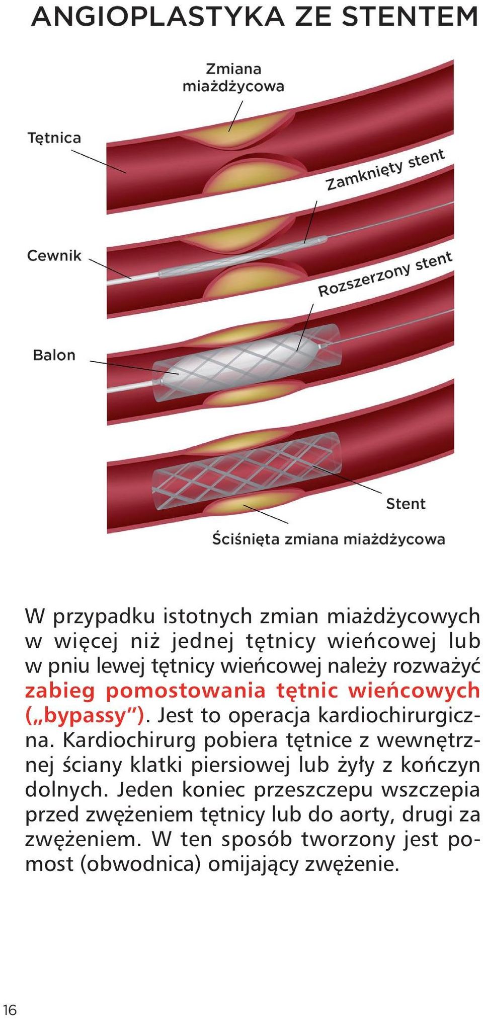 Kardiochirurg pobiera tętnice z wewnętrznej ściany klatki piersiowej lub żyły z kończyn dolnych.