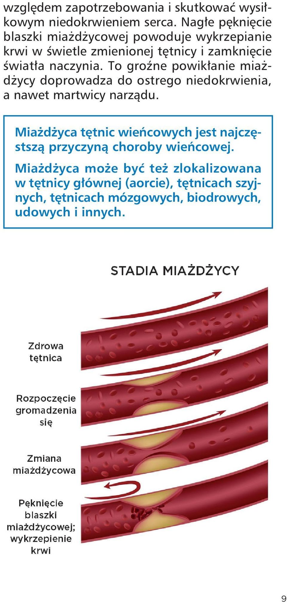 naczynia. To groźne powikłanie miażdży cy doprowadza do ostrego niedokrwienia, a nawet martwicy narządu.