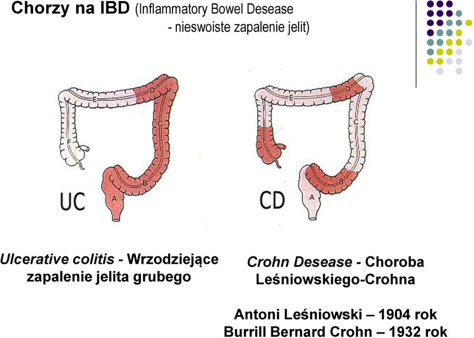 zapalenie jelita grubego Crohn Desease - Choroba