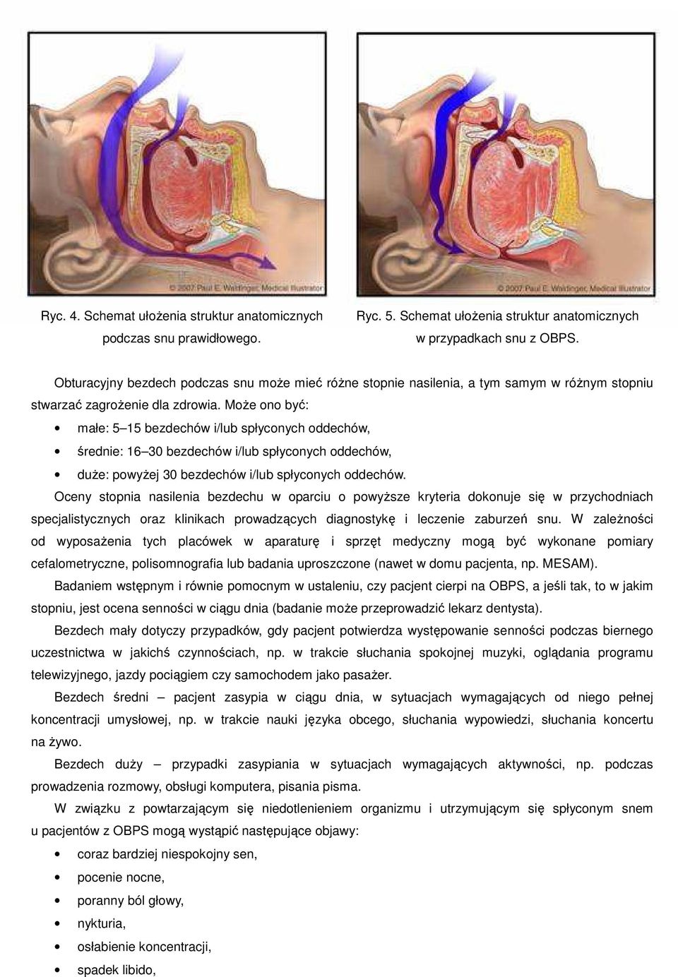 MoŜe ono być: małe: 5 15 bezdechów i/lub spłyconych oddechów, średnie: 16 30 bezdechów i/lub spłyconych oddechów, duŝe: powyŝej 30 bezdechów i/lub spłyconych oddechów.