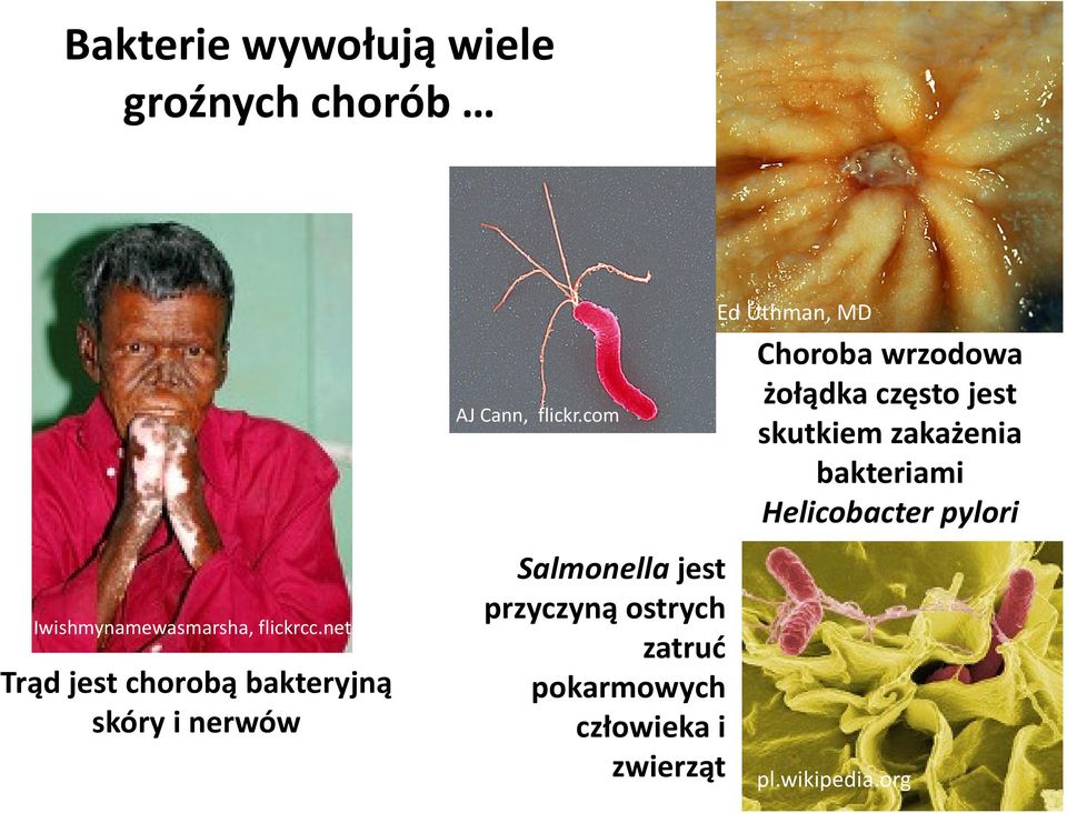 com Ed Uthman, MD Choroba wrzodowa żołądka często jest skutkiem zakażenia