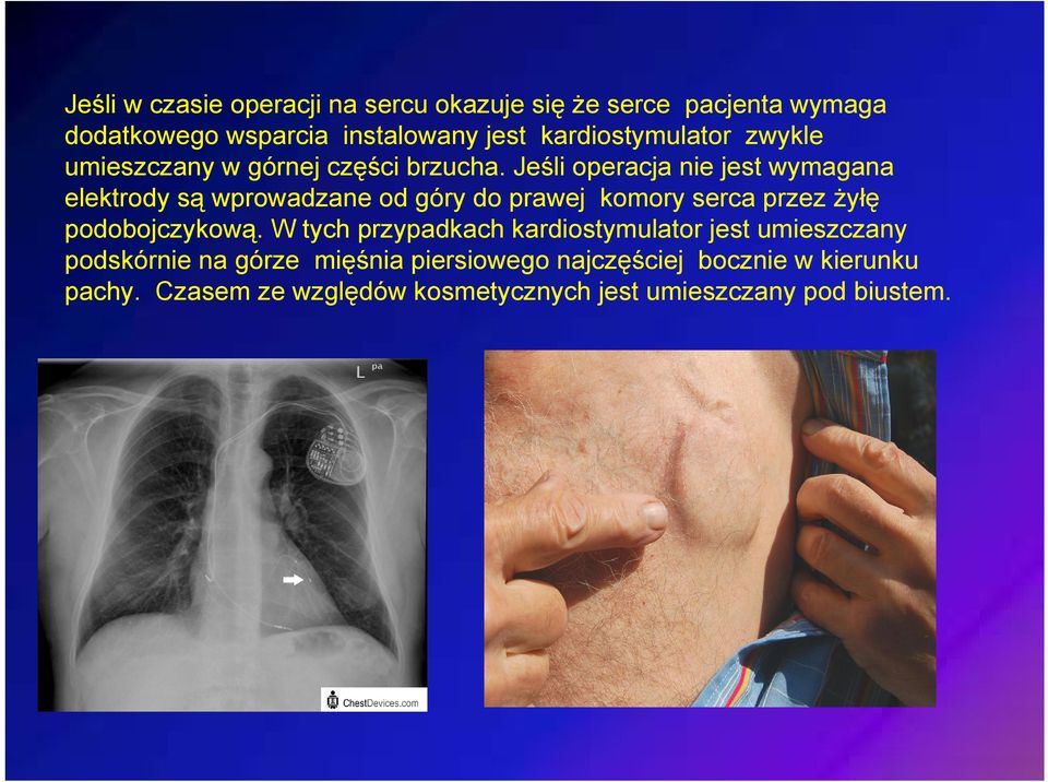 Jeśli operacja nie jest wymagana elektrody są wprowadzane od góry do prawej komory serca przez żyłę podobojczykową.