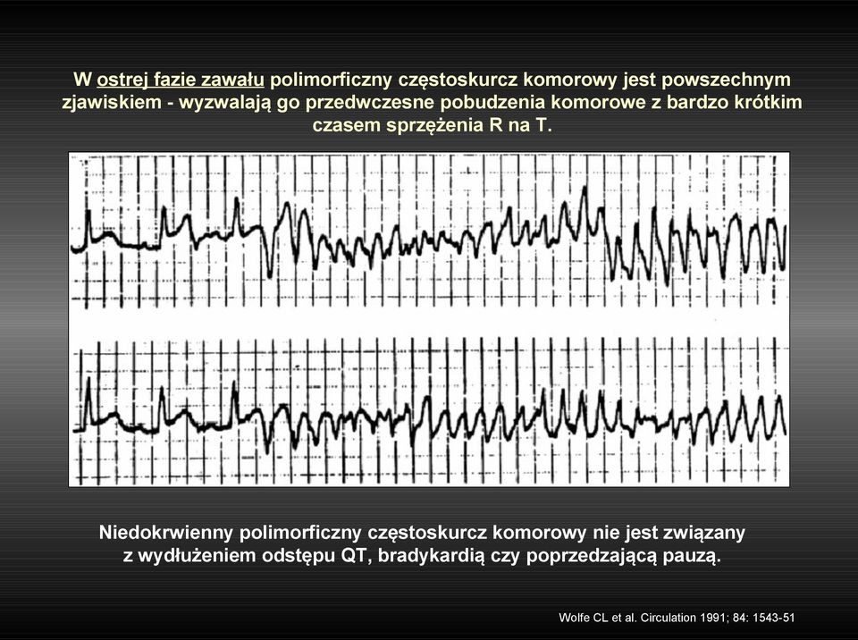 Niedokrwienny polimorficzny częstoskurcz komorowy nie jest związany z wydłużeniem