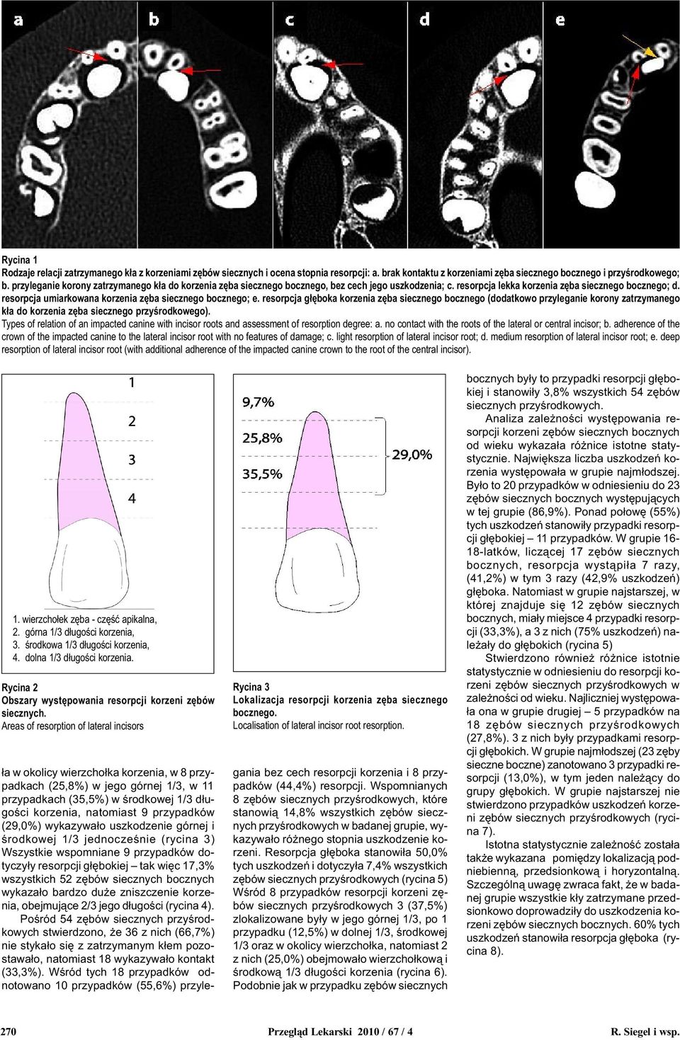 resorpcja umiarkowana korzenia zêba siecznego bocznego; e. resorpcja g³êboka korzenia zêba siecznego bocznego (dodatkowo przyleganie korony zatrzymanego k³a do korzenia zêba siecznego przyœrodkowego).