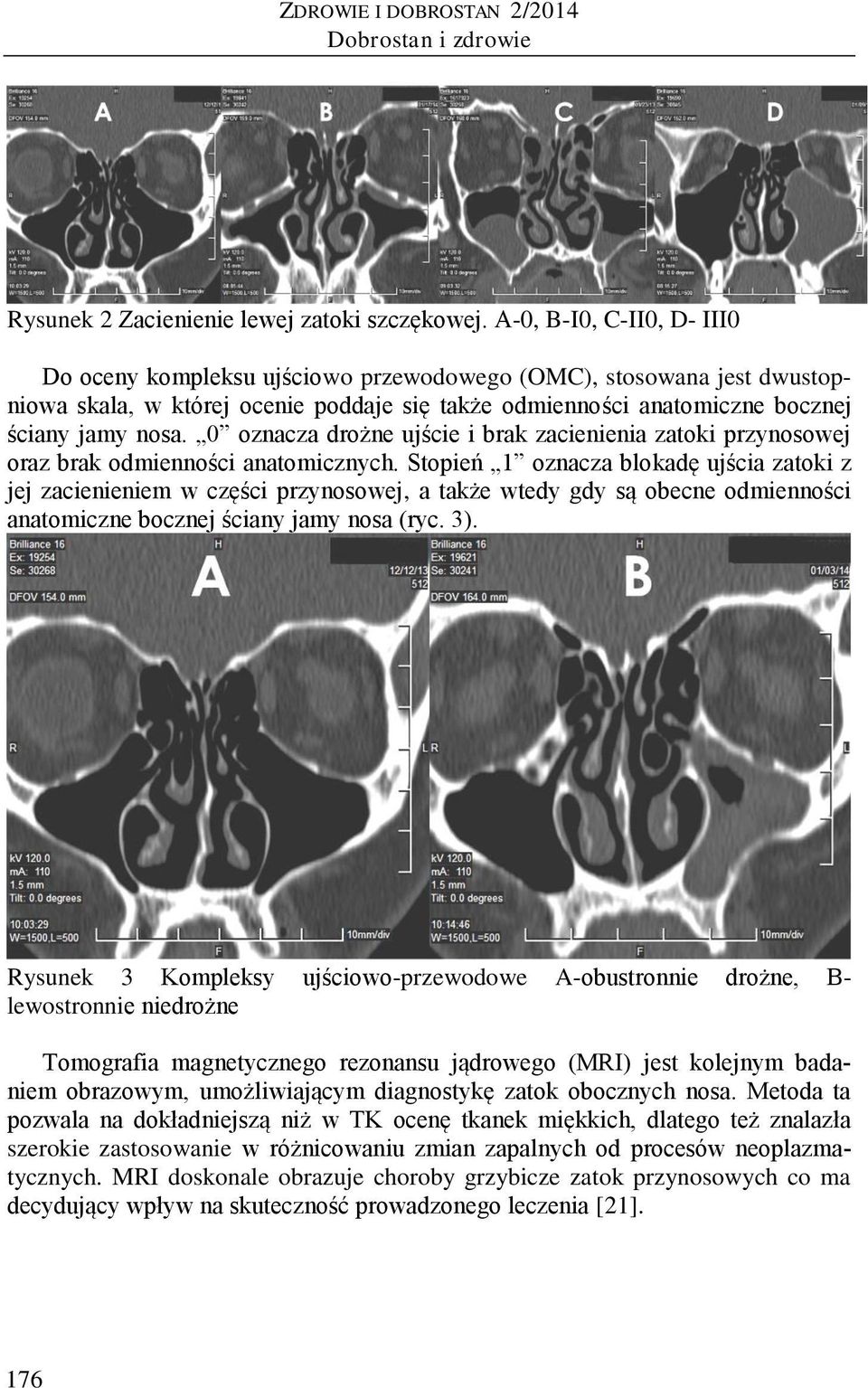 0 oznacza drożne ujście i brak zacienienia zatoki przynosowej oraz brak odmienności anatomicznych.