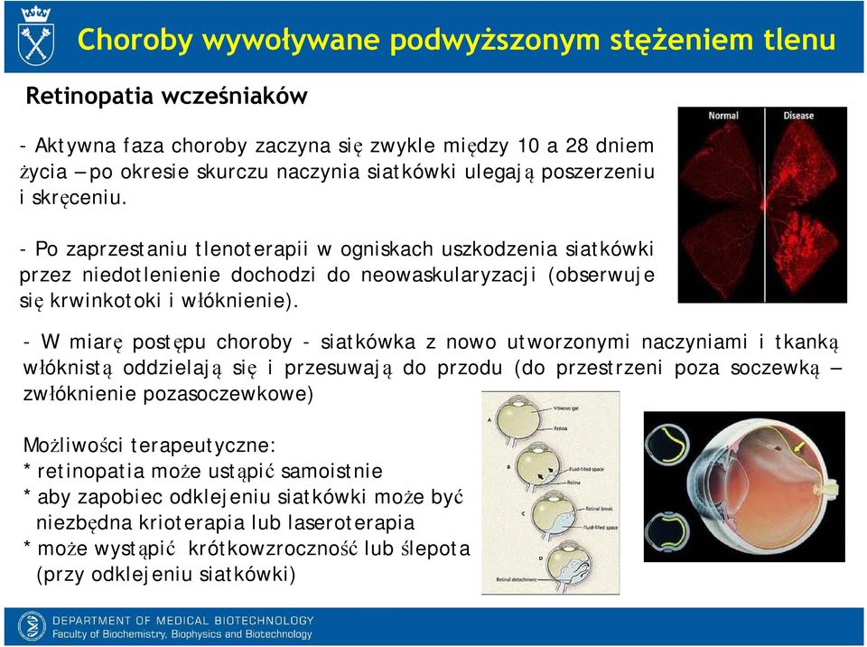 -W miarę postępu choroby - siatkówka z nowo utworzonymi naczyniami i tkanką włóknistą oddzielają się i przesuwają do przodu (do przestrzeni poza soczewką zwłóknienie pozasoczewkowe) Możliwości