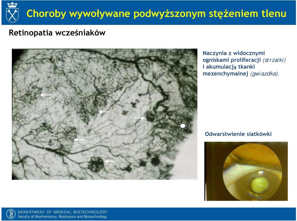 ogniskami proliferacji (strzałki) i akumulacją