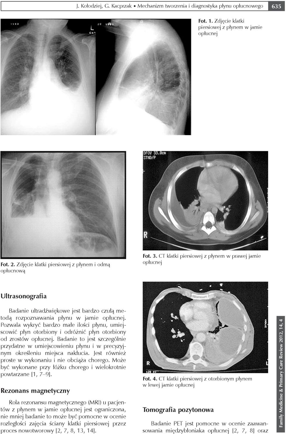 CT klatki piersiowej z płynem w prawej jamie opłucnej Ultrasonografia Badanie ultradźwiękowe jest bardzo czułą metodą rozpoznawania płynu w jamie opłucnej.