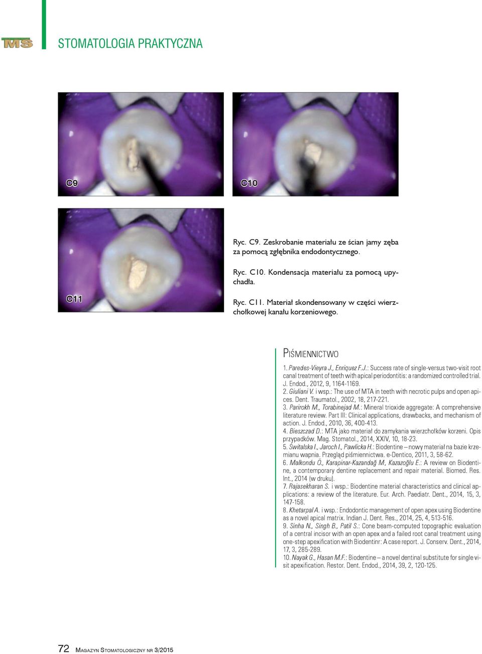 , Enriquez F.J.: Success rate of single versus two visit root canal treatment of teeth with apical periodontitis: a randomized controlled trial. J. Endod., 2012, 9, 1164 1169. 2. Giuliani V. i wsp.