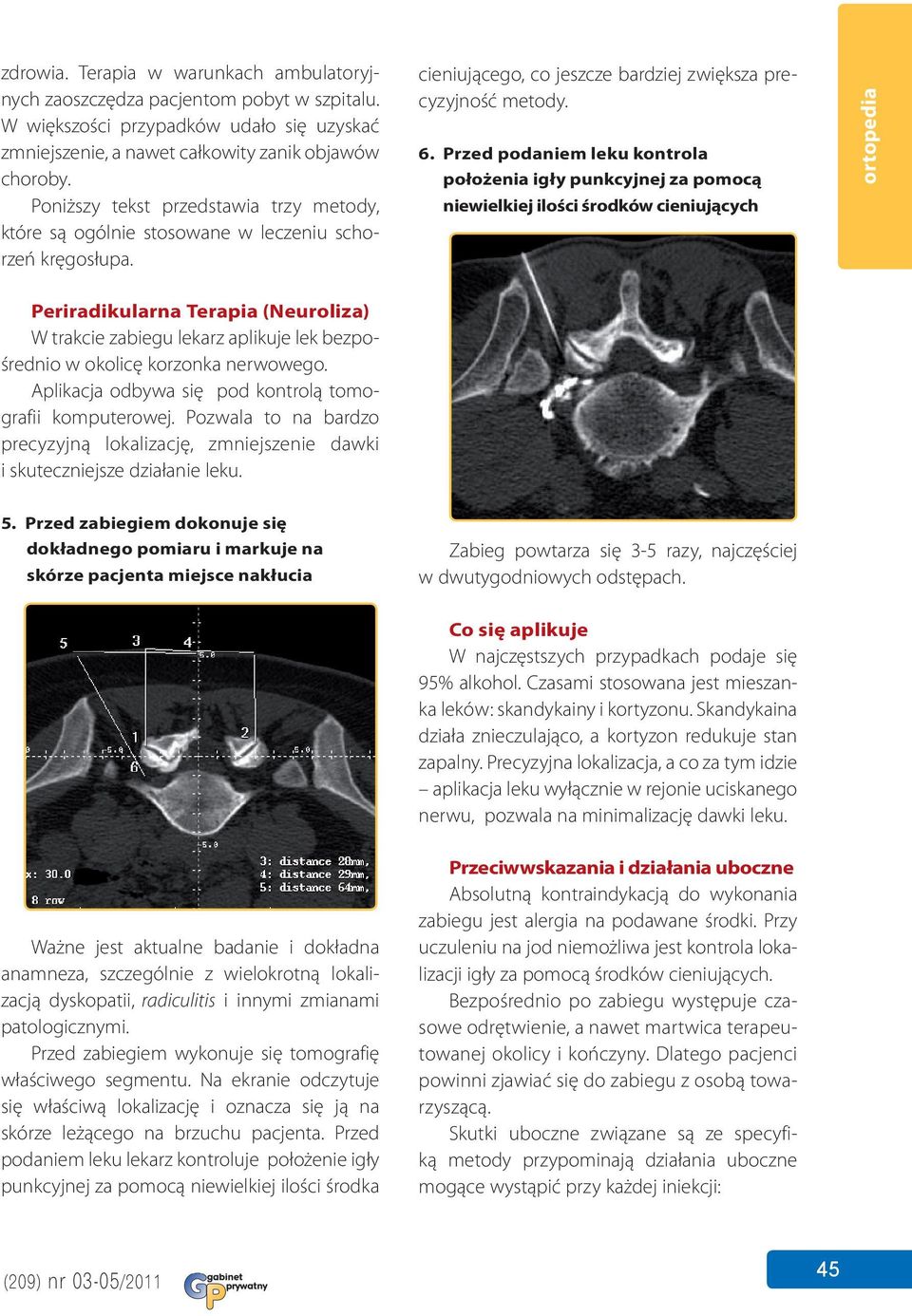 Przed podaniem leku kontrola położenia igły punkcyjnej za pomocą niewielkiej ilości środków cieniujących ortopedia Periradikularna Terapia (Neuroliza) W trakcie zabiegu lekarz aplikuje lek