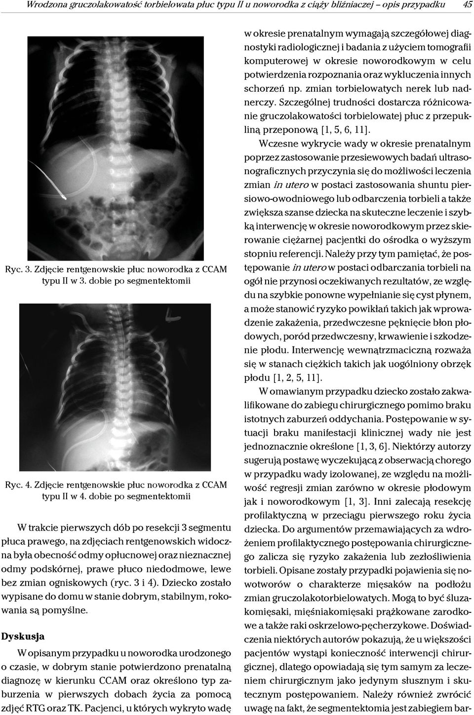 niedodmowe, lewe bez zmian ogniskowych (ryc. 3 i 4). Dziecko zostało wypisane do domu w stanie dobrym, stabilnym, rokowania są pomyślne.