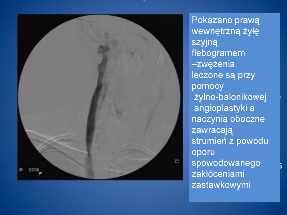 angioplastyki a naczynia oboczne zawracają strumień