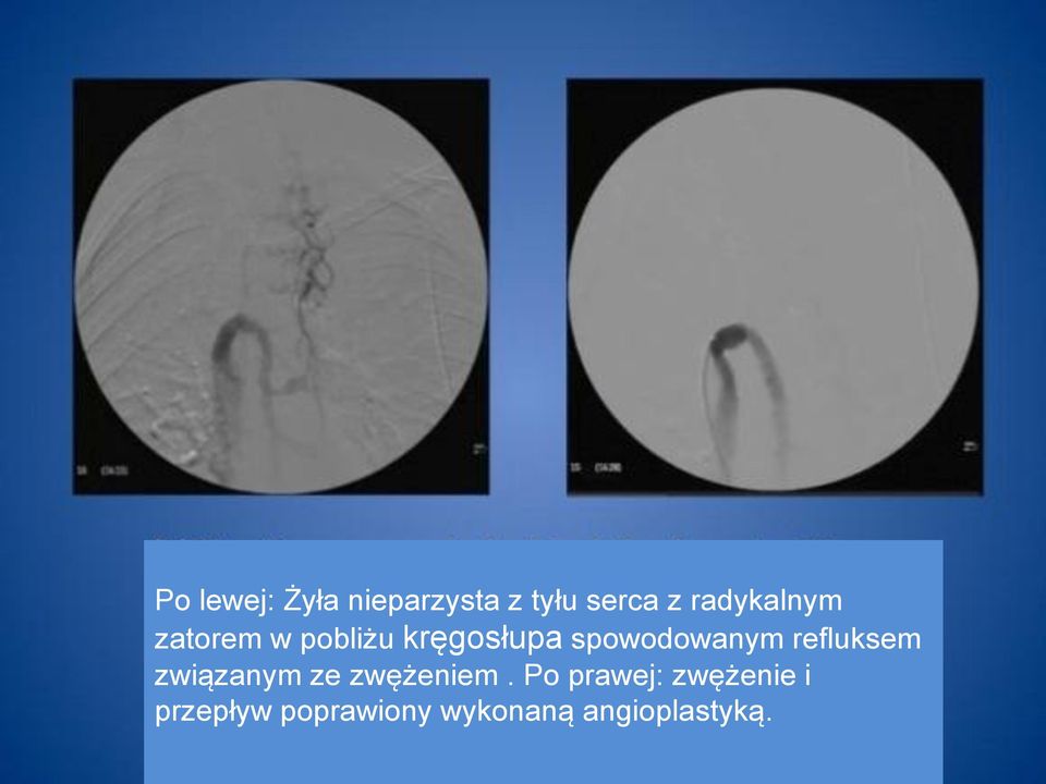 spowodowanym refluksem związanym ze zwężeniem.