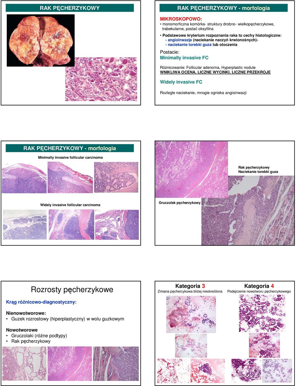 OCENA, LICZNE WYCINKI, LICZNE PRZEKROJE Widely invasive FC Rozległe naciekanie, mnogie ogniska angioinwazji RAK PĘCHERZYKOWY - morfologia Minimally invasive follicular carcinoma Rak pęcherzykowy