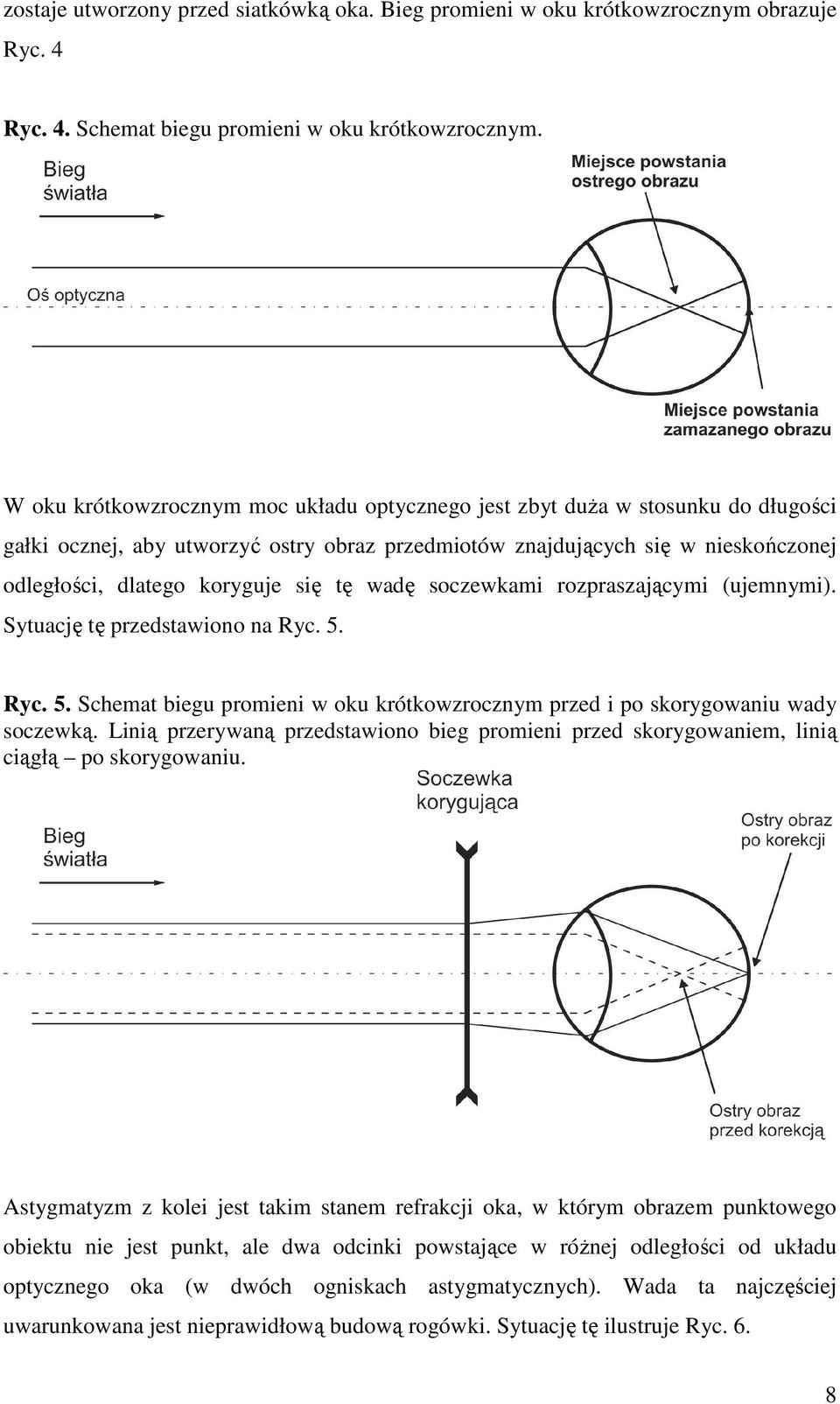 tę wadę soczewkami rozpraszającymi (ujemnymi). Sytuację tę przedstawiono na Ryc. 5. Ryc. 5. Schemat biegu promieni w oku krótkowzrocznym przed i po skorygowaniu wady soczewką.