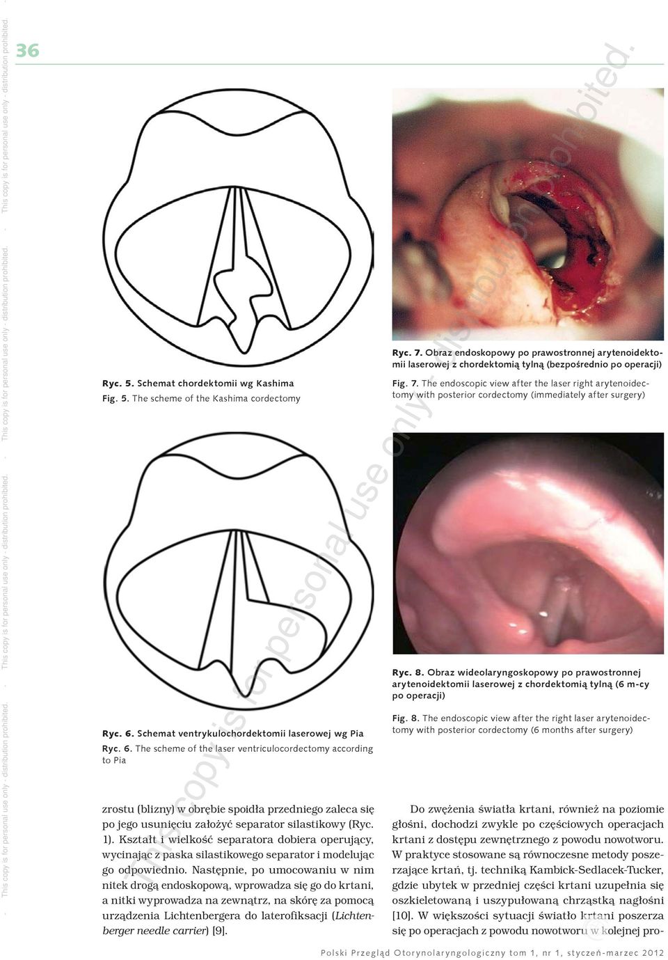 The scheme of the laser ventriculocordectomy according to Pia zrostu (blizny) w obrębie spoidła przedniego zaleca się po jego usunięciu założyć separator silastikowy (Ryc. 1).