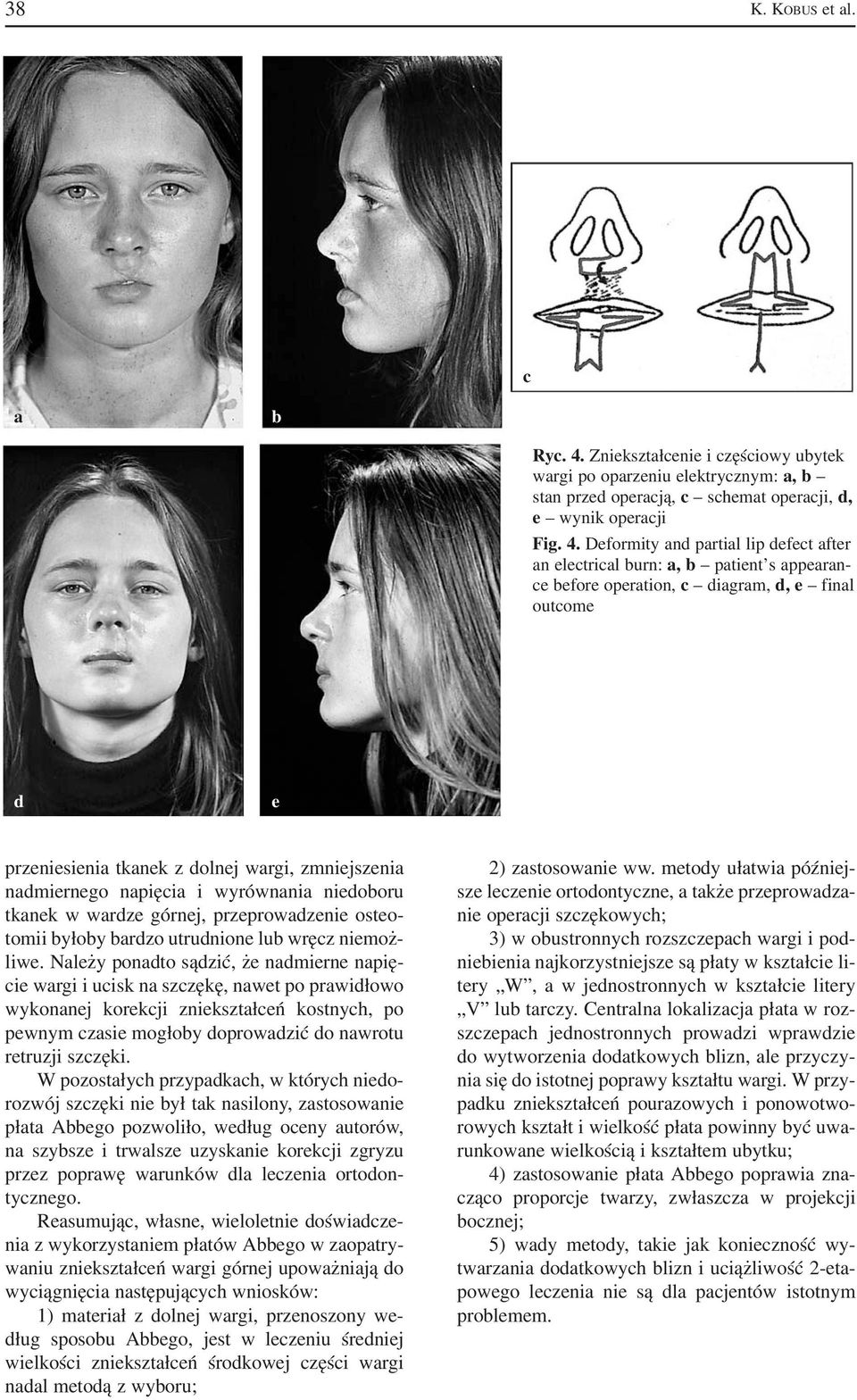 Deformity and partial lip defect after an electrical burn: a, b patient s appearan ce before operation, c diagram, d, e final outcome d e przeniesienia tkanek z dolnej wargi, zmniejszenia nadmiernego