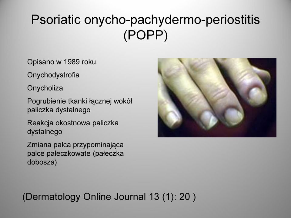 dystalnego Reakcja okostnowa paliczka dystalnego Zmiana palca