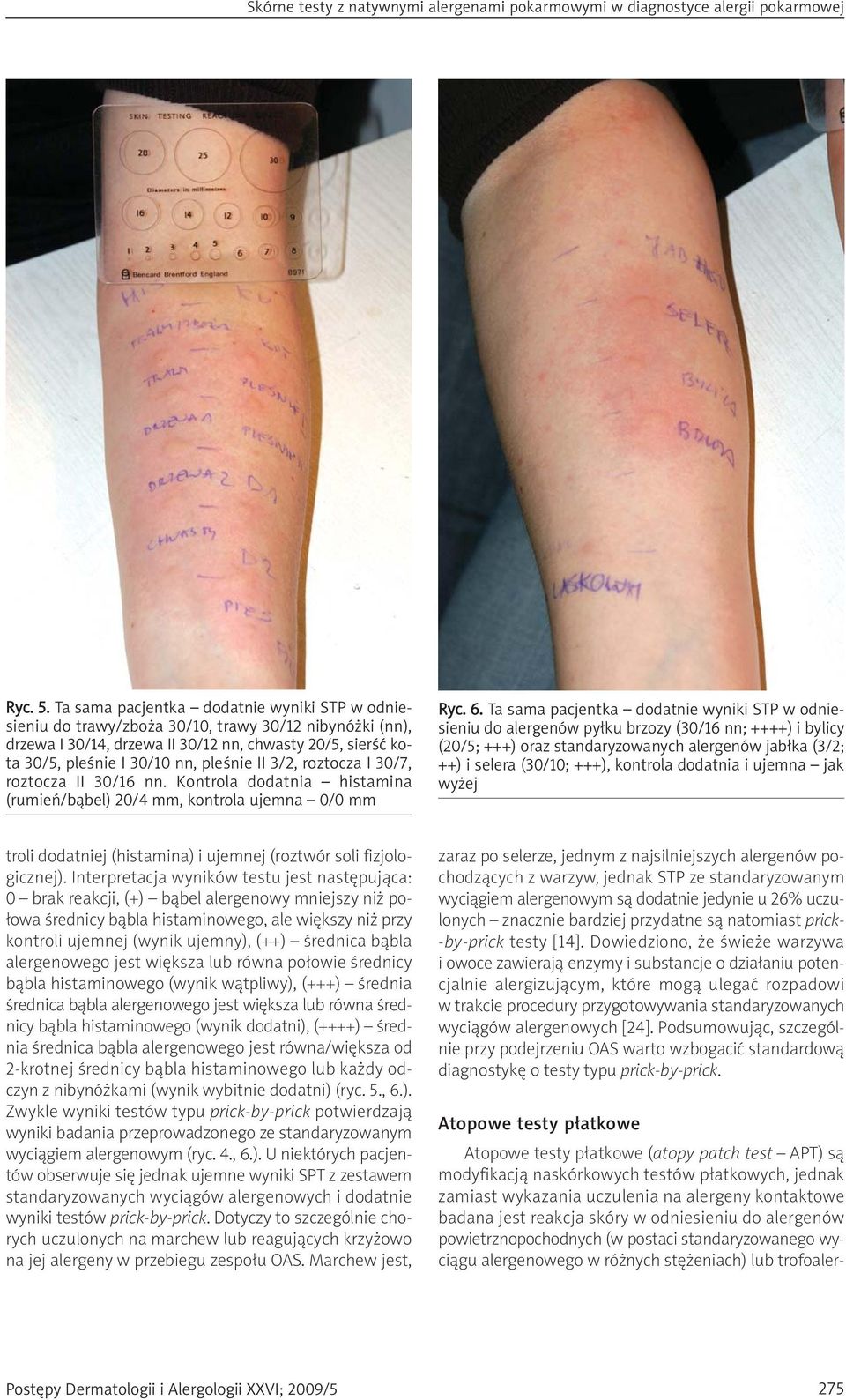 II 3/2, roztocza I 30/7, roztocza II 30/16 nn. Kontrola dodatnia histamina (rumień/bąbel) 20/4 mm, kontrola ujemna 0/0 mm Ryc. 6.