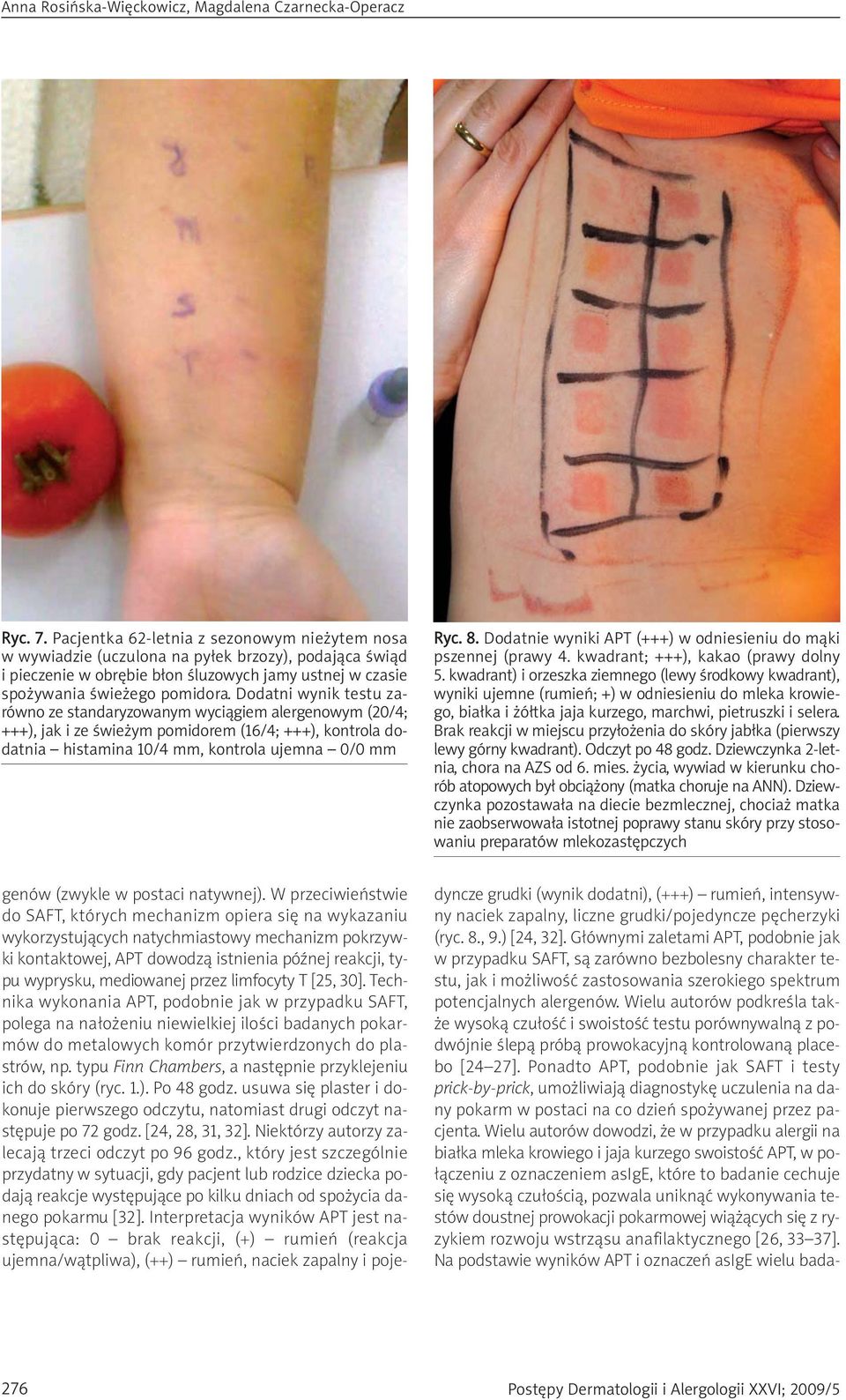 Dodatni wynik testu zarówno ze standaryzowanym wyciągiem alergenowym (20/4; +++), jak i ze świeżym pomidorem (16/4; +++), kontrola dodatnia histamina 10/4 mm, kontrola ujemna 0/0 mm Ryc. 8.