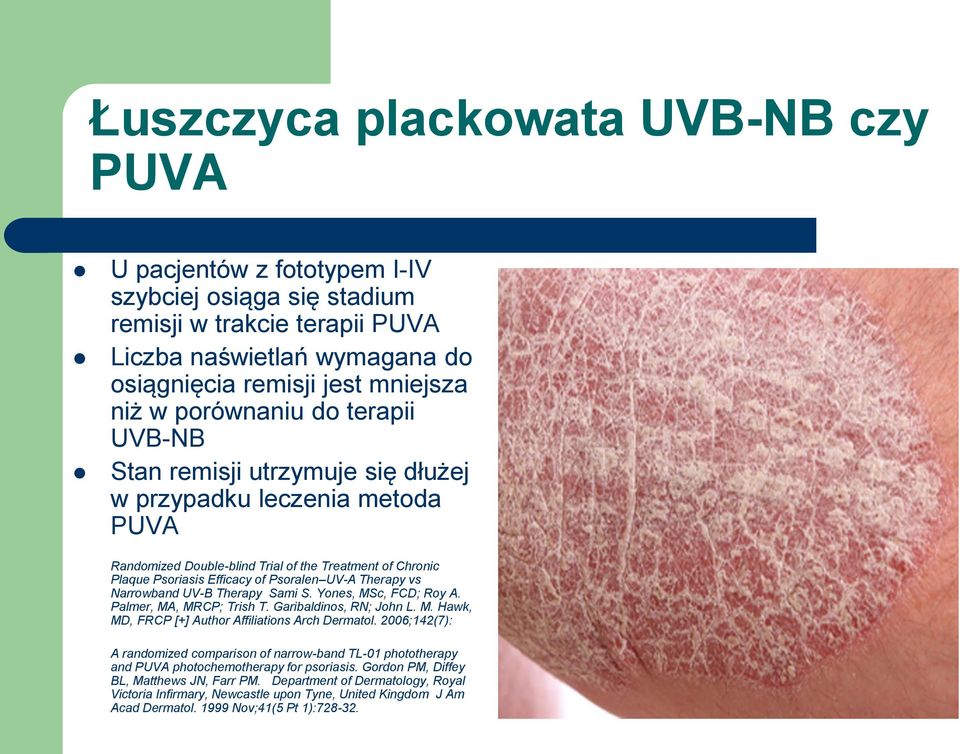 Therapy vs Narrowband UV-B Therapy Sami S. Yones, MSc, FCD; Roy A. Palmer, MA, MRCP; Trish T. Garibaldinos, RN; John L. M. Hawk, MD, FRCP [+] Author Affiliations Arch Dermatol.