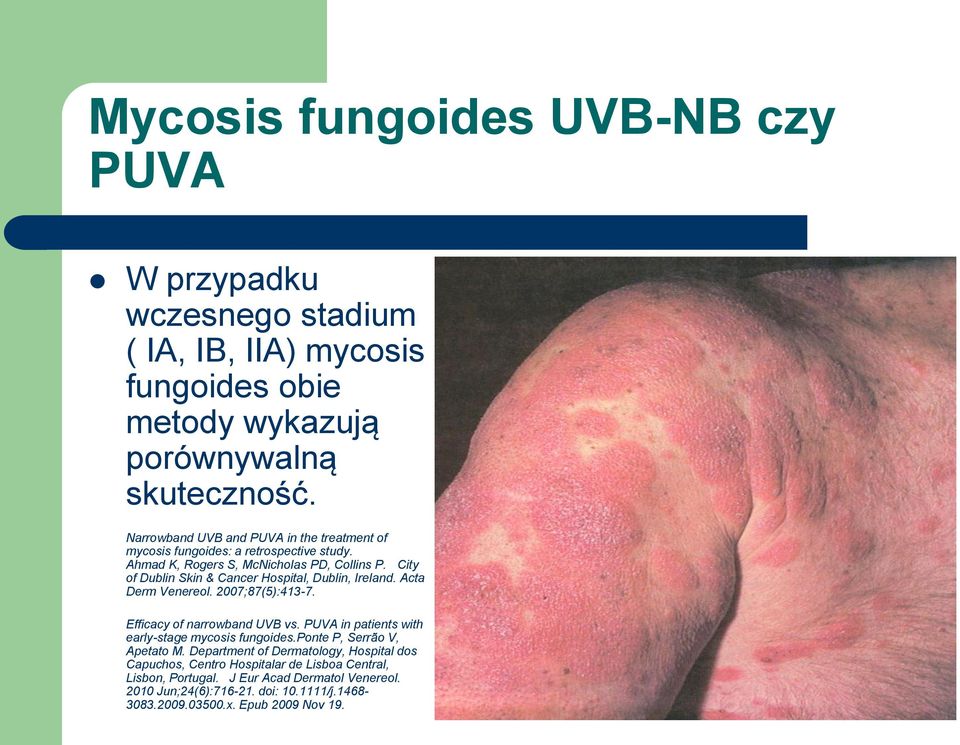 City of Dublin Skin & Cancer Hospital, Dublin, Ireland. Acta Derm Venereol. 2007;87(5):413-7. Efficacy of narrowband UVB vs.