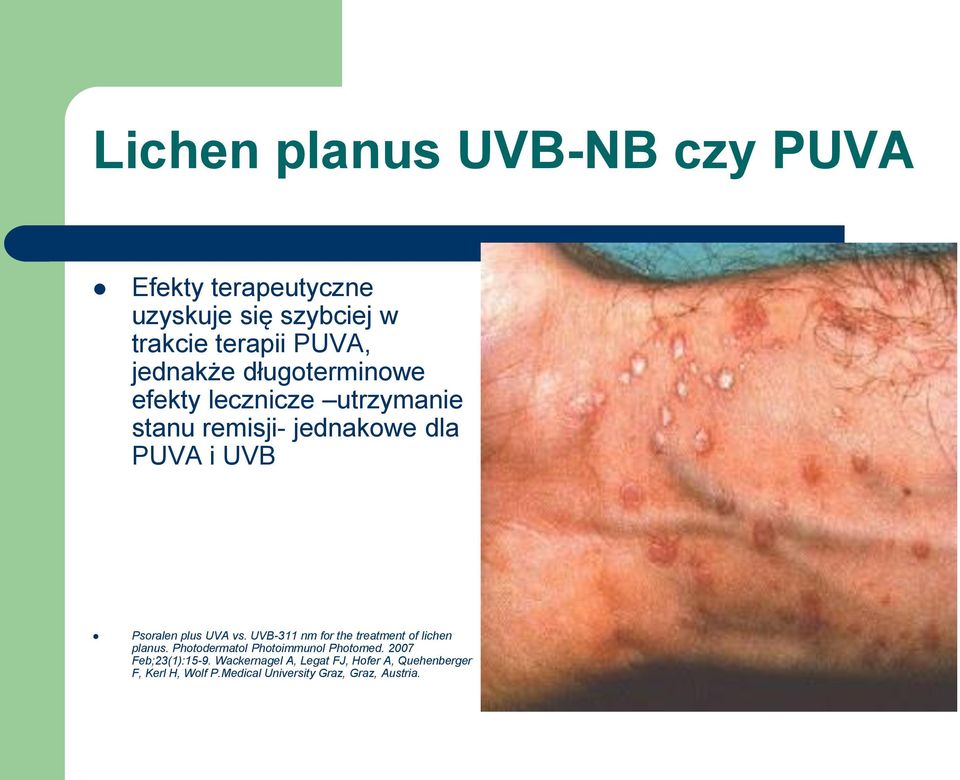 plus UVA vs. UVB-311 nm for the treatment of lichen planus. Photodermatol Photoimmunol Photomed.