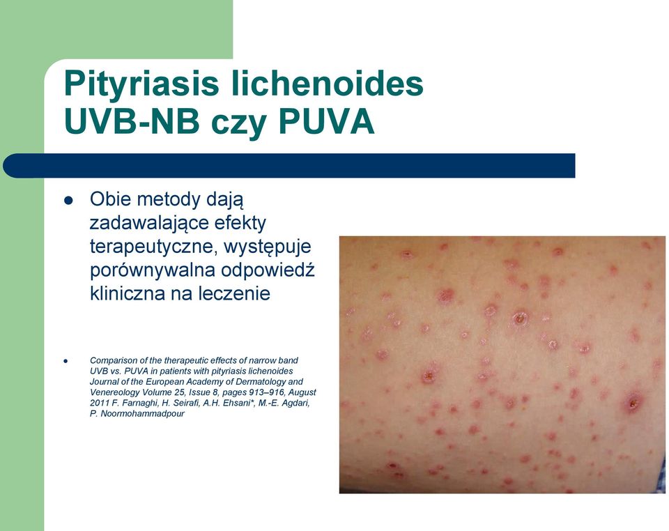 PUVA in patients with pityriasis lichenoides Journal of the European Academy of Dermatology and Venereology