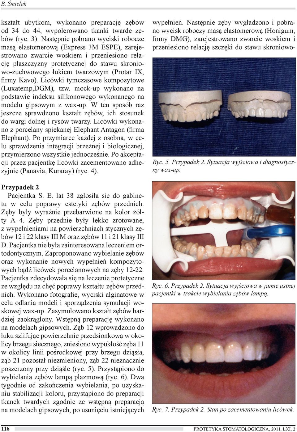 (Protar IX, firmy Kavo). Licówki tymczasowe kompozytowe (Luxatemp,DGM), tzw. mock-up wykonano na podstawie indeksu silikonowego wykonanego na modelu gipsowym z wax-up.