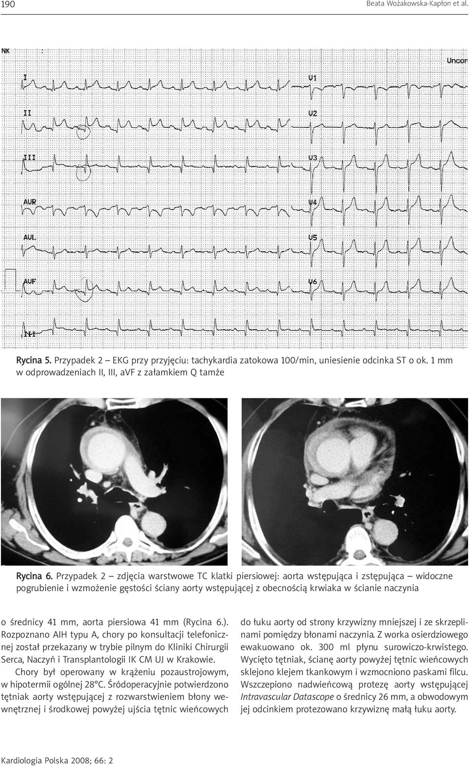 41 mm, aorta piersiowa 41 mm (Rycina 6.).