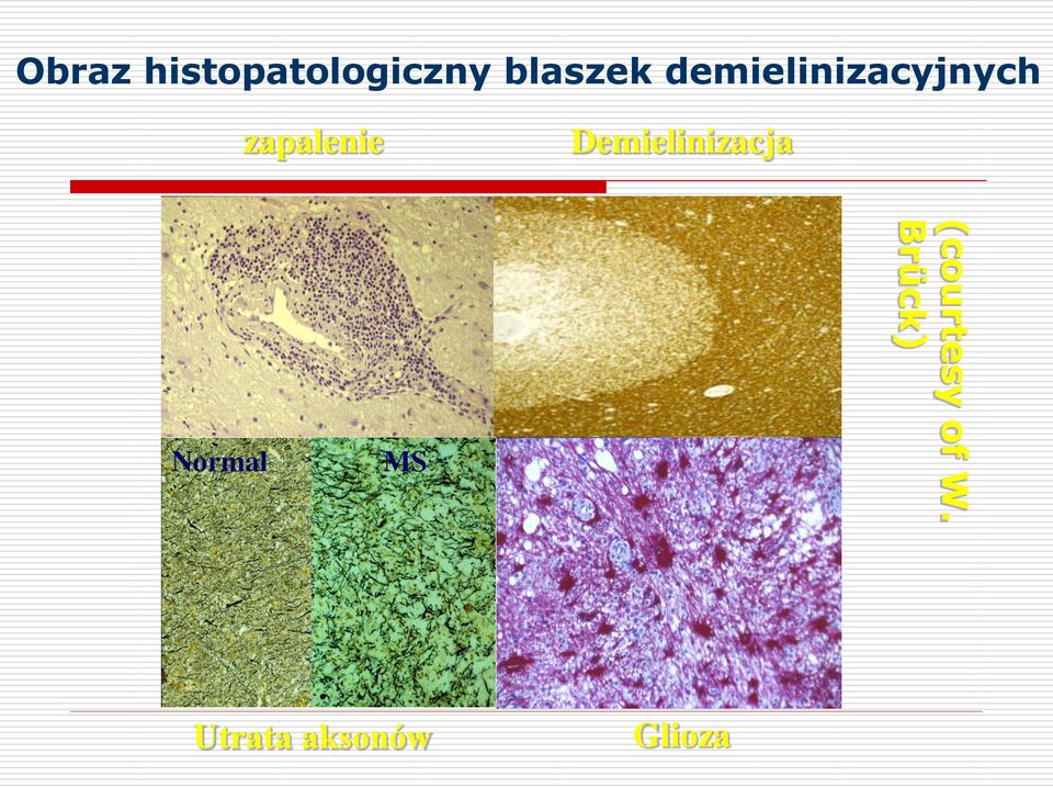 Demielinizacja Normal MS