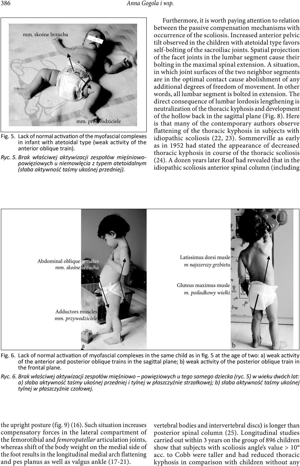 Incresed nterior pelvic tilt oserved in the children with tetoidl type fvors self-olting of the scroilic joints.