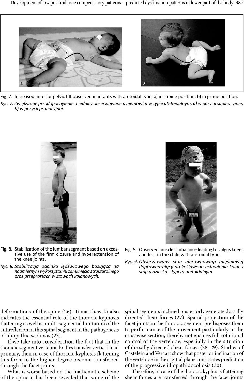 Zwiększone przodopochylenie miednicy oserwowne u niemowląt w typie tetoidlnym: ) w pozycji supincyjnej; ) w pozycji proncyjnej. Fig. 8.