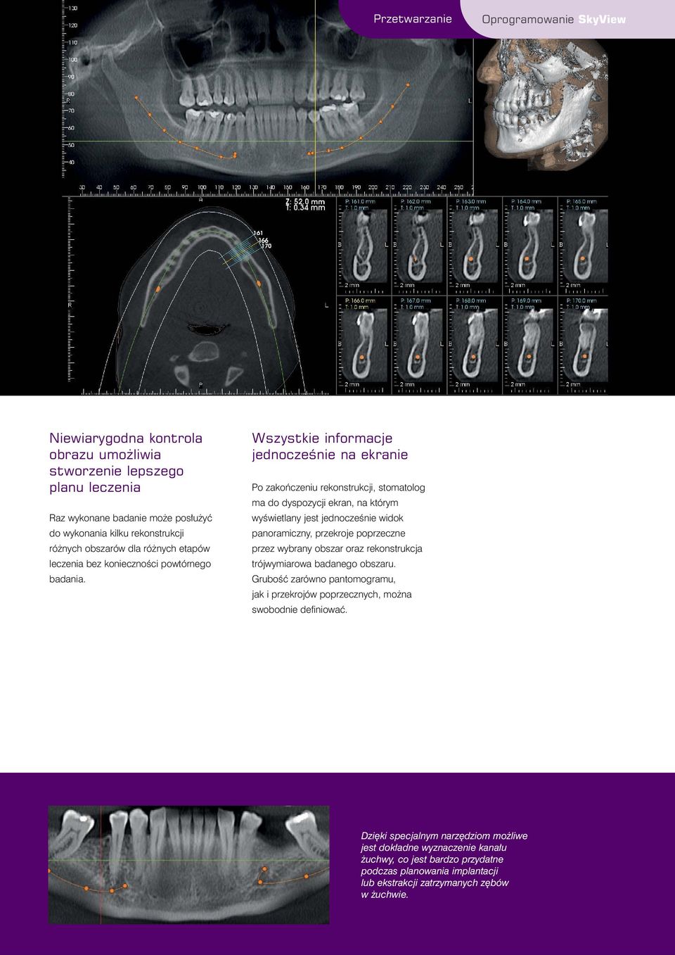 Wszystkie informacje jednoczeênie na ekranie Po zakoƒczeniu rekonstrukcji, stomatolog ma do dyspozycji ekran, na którym wyêwietlany jest jednoczeênie widok panoramiczny, przekroje poprzeczne przez
