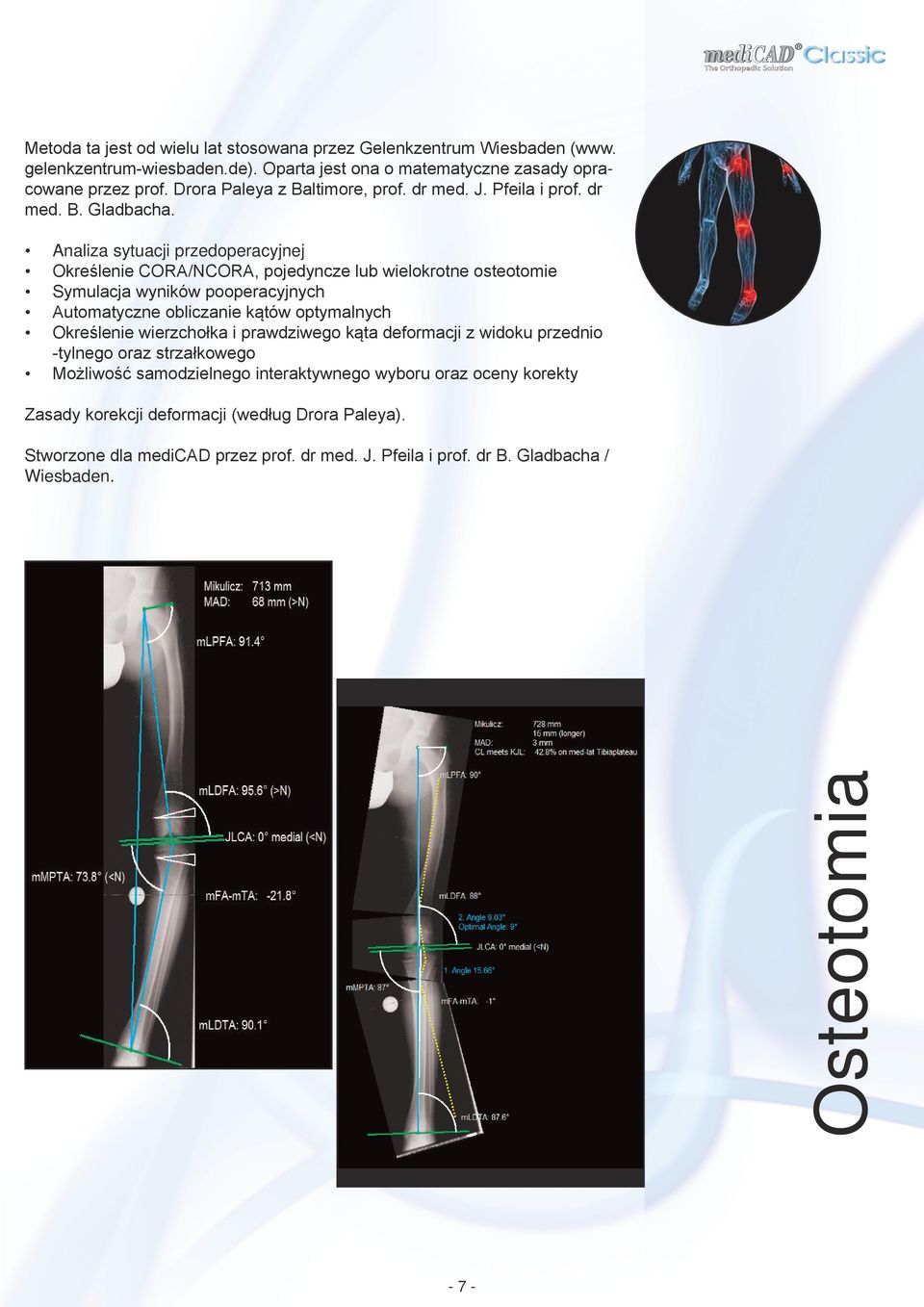 Analiza sytuacji przedoperacyjnej Określenie CORA/NCORA, pojedyncze lub wielokrotne osteotomie Symulacja wyników pooperacyjnych Automatyczne obliczanie kątów optymalnych Określenie