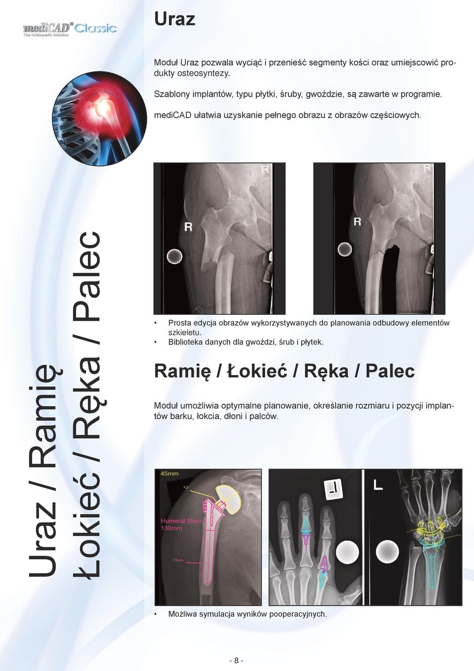 Uraz / Ramię Łokieć / Ręka / Palec Prosta edycja obrazów wykorzystywanych do planowania odbudowy elementów szkieletu.