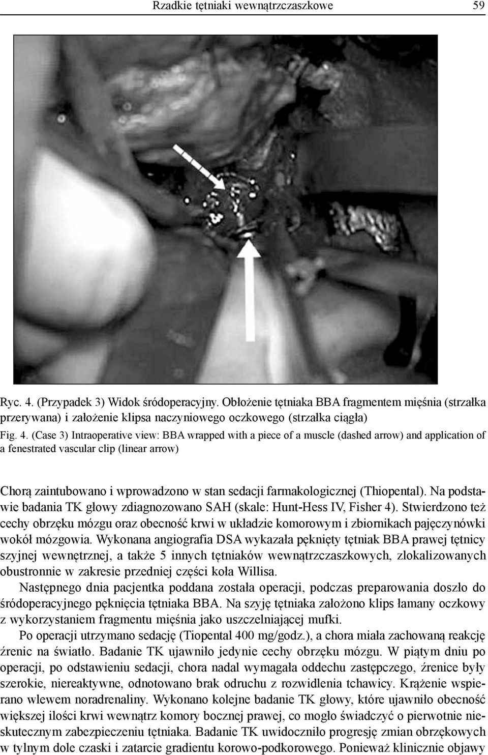 (Case 3) Intraoperative view: BBA wrapped with a piece of a muscle (dashed arrow) and application of a fenestrated vascular clip (linear arrow) Chorą zaintubowa i wprowadzo w stan sedacji