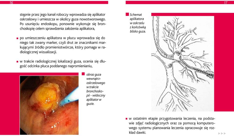 znacznikami markującymi źródło promieniotwórcze, który pomaga w radiologicznej wizualizacji. Schemat aplikatora w oskrzelu z kon cówką blisko guza.