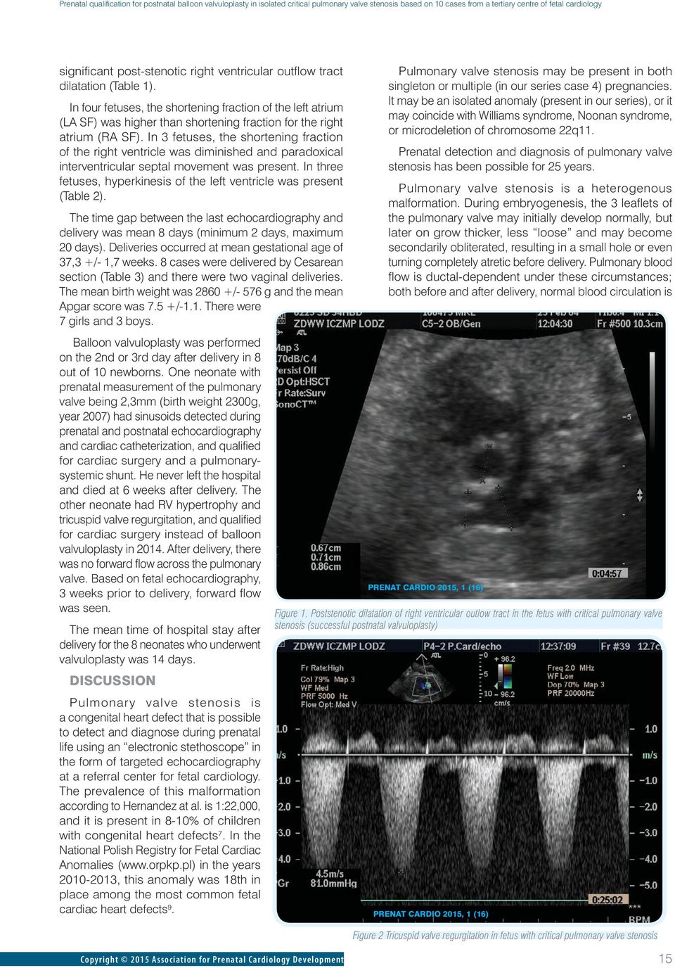 In 3 fetuses, the shortening fraction of the right ventricle was diminished and paradoxical interventricular septal movement was present.