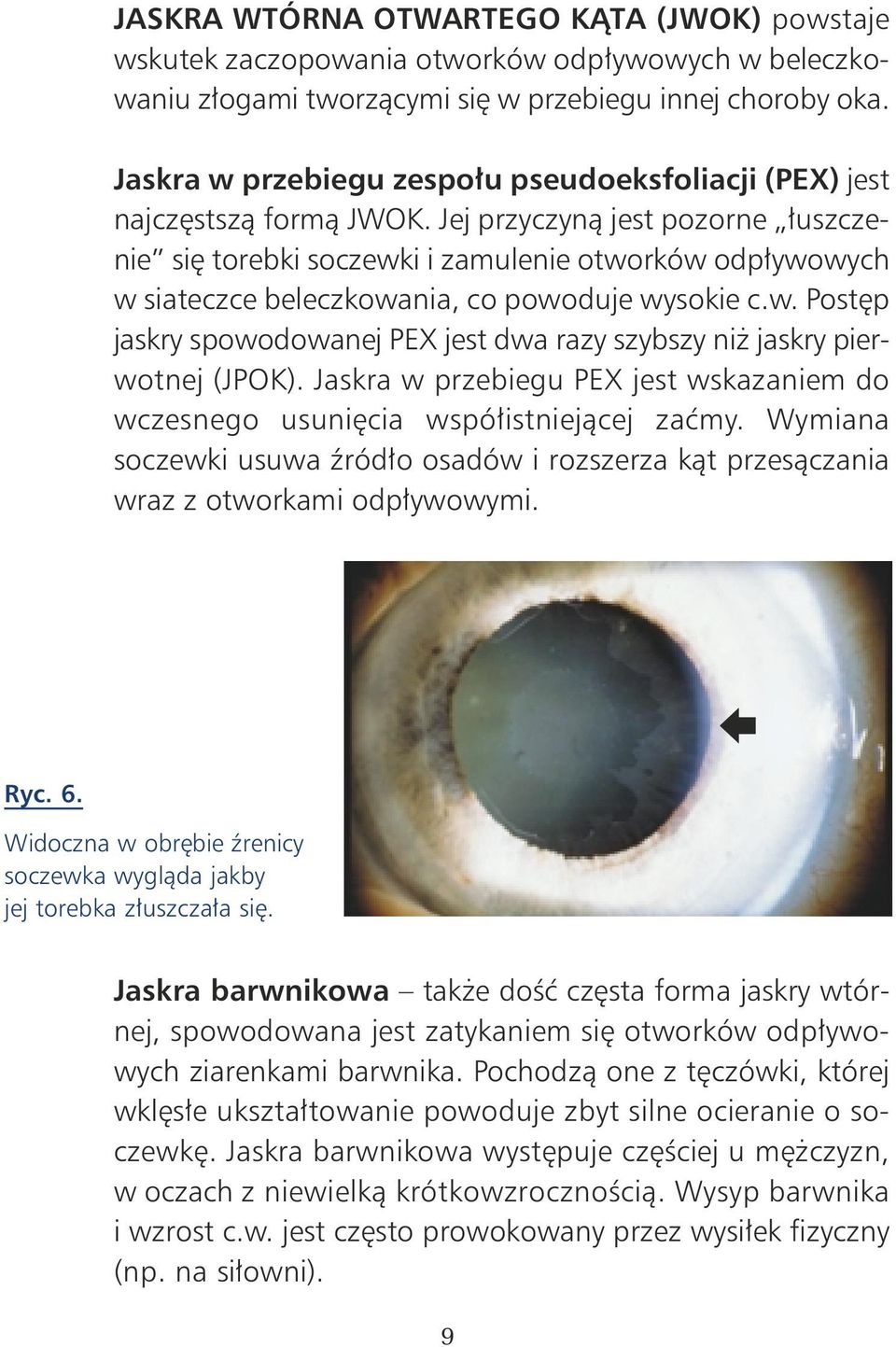 Jej przyczynà jest pozorne uszczenie si torebki soczewki i zamulenie otworków odp ywowych w siateczce beleczkowania, co powoduje wysokie c.w. Post p jaskry spowodowanej PEX jest dwa razy szybszy ni jaskry pierwotnej (JPOK).