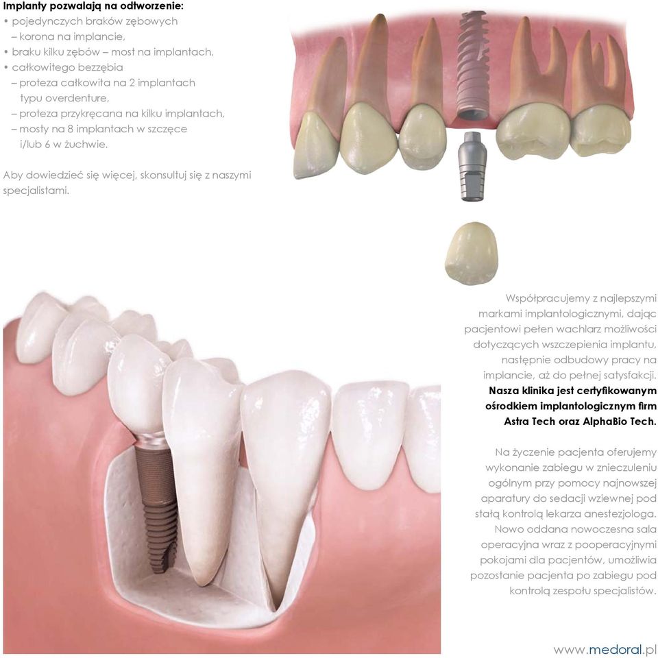 Współpracujemy z najlepszymi markami implantologicznymi, dając pacjentowi pełen wachlarz możliwości dotyczących wszczepienia implantu, następnie odbudowy pracy na implancie, aż do pełnej satysfakcji.