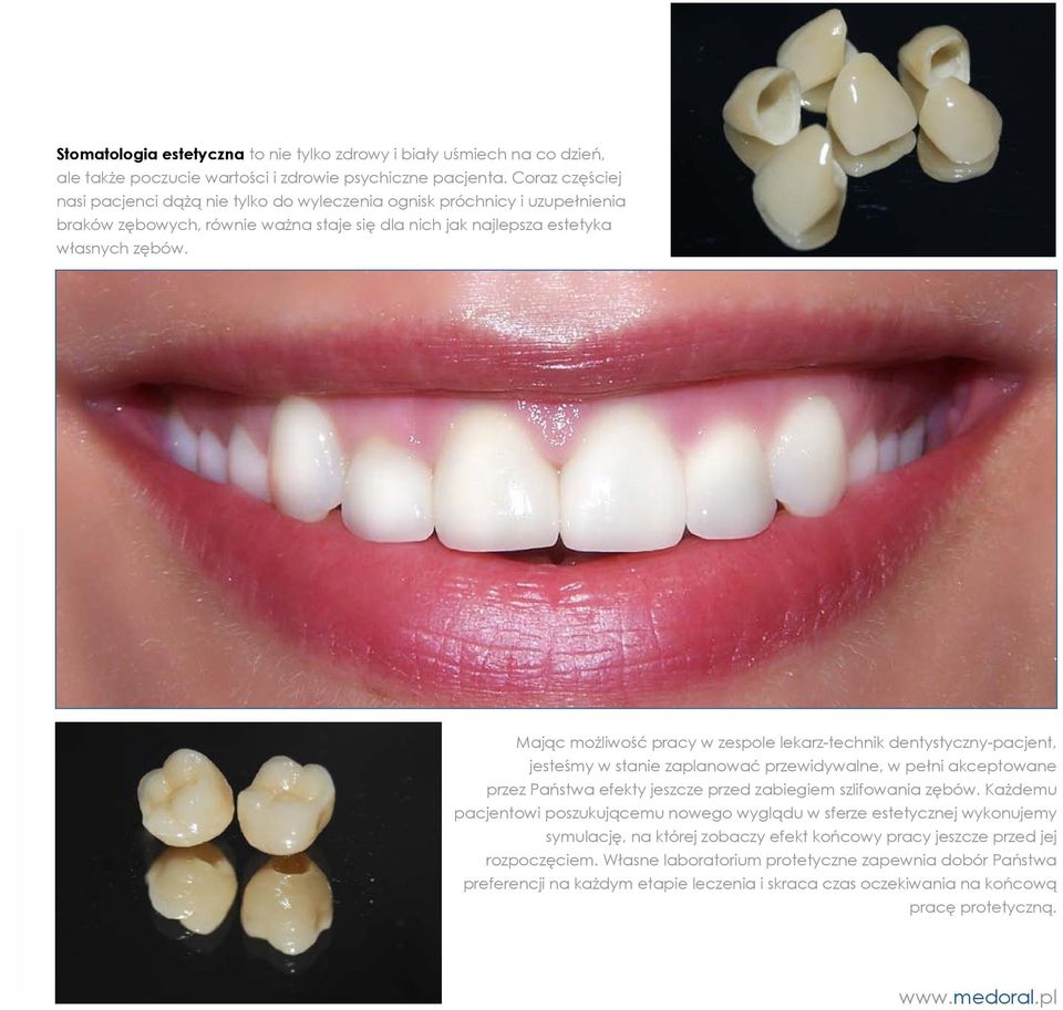 Mając możliwość pracy w zespole lekarz-technik dentystyczny-pacjent, jesteśmy w stanie zaplanować przewidywalne, w pełni akceptowane przez Państwa efekty jeszcze przed zabiegiem szlifowania zębów.