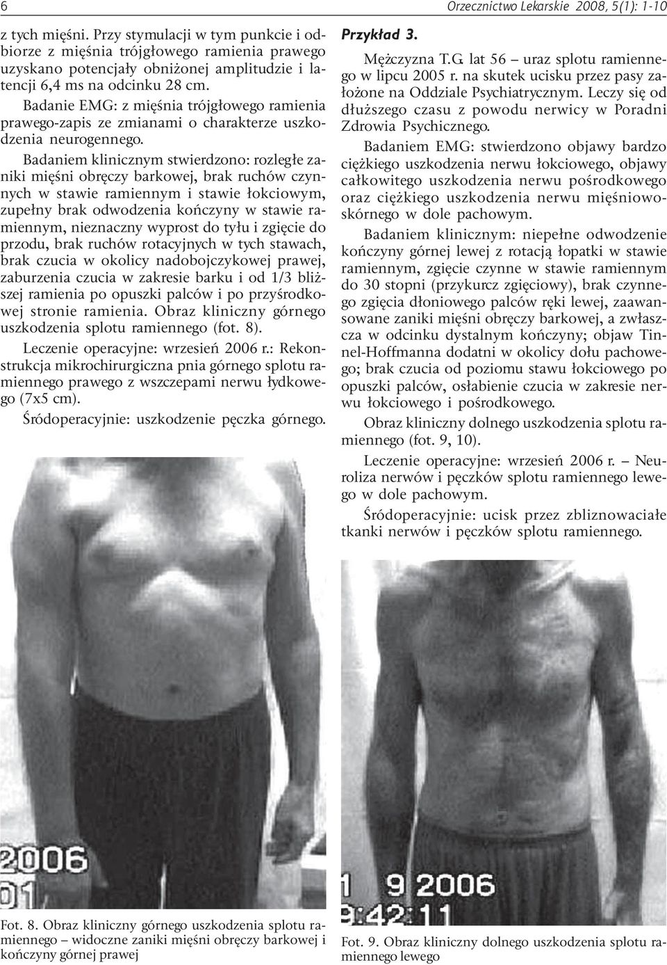 Badanie EMG: z miêœnia trójg³owego ramienia prawego-zapis ze zmianami o charakterze uszkodzenia neurogennego.